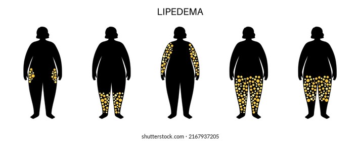 Lipedema disease concept. Accumulating fat in the lover part of the female body. Buttocks, hips and calves problems. Cellulite, overweight and swollen. Adipose tissue disorder flat vector illustration svg