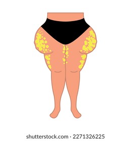 Lipedema fat cells on overweight female body