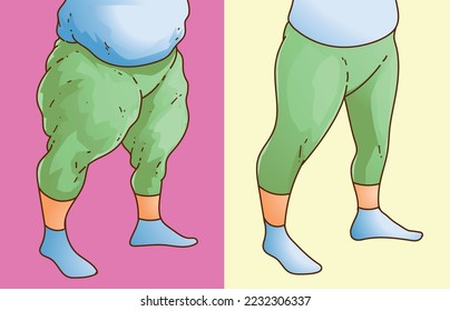 Lipedema. Women's legs with health problems. Before, after. Healthcare illustration, medical infographics. Vector illustration. svg