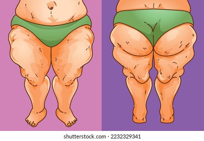 Lipedema. Women's legs with health problems. Healthcare illustration, medical infographics. Vector illustration. svg