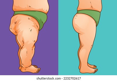 Lipedema. Women's legs with health problems. Before, after. Healthcare illustration, medical infographics. Vector illustration. svg
