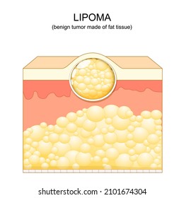 Lipoma. adipose tumors located into the subcutaneous tissues in the skin. Vector illustration. Skin layers svg