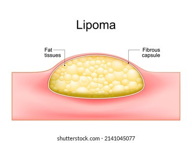 Lipoma. adipose tumors located into the subcutaneous tissues in the skin. Cross section of a human skin. Vector illustration. svg