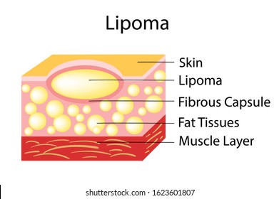Lipoma are adipose tumors located in the subcutaneous tissues, vector illustration svg