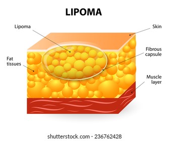 Lipoma are adipose tumors located in the subcutaneous tissues. svg