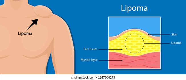 Lipoma disease tissue fatty grows body skin soft hurt pain madelung diagnose physical exam biopsy test removal svg