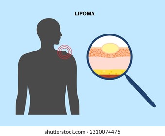 Lipoma fatty tumor medical poster. Not cancer, benign tumor under skin, fat lump in human body. Skin layers structure epidermis, dermis and hypodermis and muscle medical flat vector illustration