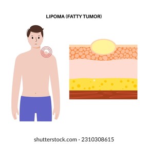 Lipoma fatty tumor medical poster. Not cancer, benign tumor under skin, fat lump in human body. Skin layers structure epidermis, dermis and hypodermis and muscle medical flat vector illustration