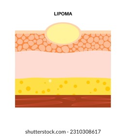 Afiche médico de tumor graso de lipoma. No cáncer, tumor benigno bajo la piel, bulto de grasa en el cuerpo humano. Estructura de las capas de la piel epidermis, dermis e hipodérmis e ilustración de los vectores planos médicos musculares