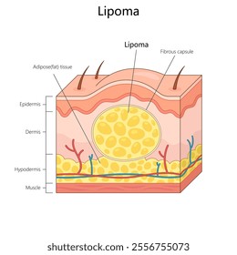 lipoma with labeled skin layers, including epidermis, dermis, hypodermis, and fibrous capsule structure diagram hand drawn schematic vector illustration. Medical science educational illustration