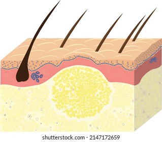 esquema de lipoma con ilustración cutánea, vectorial, gráfica, vectorial