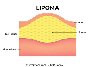 Lipoma Science Design Vector Illustration Diagram