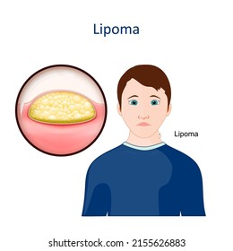 Lipoma. Skin disease. Close-up of a growth of fat tissue under human skin. Vector illustration svg