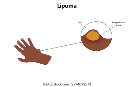 Lipoma vector illustration. Fatty tissue