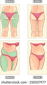 liposuction