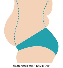 Liposuction of abdomen. Close up vector illustration of body contour with dotted line. Plastic surgery. Getting rid of excess fat.