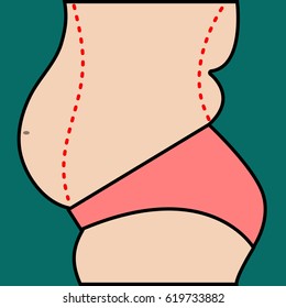 Liposuction of abdomen. Close up vector illustration of body contour with dotted line. Plastic surgery. Getting rid of excess fat.