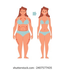 Liposuction and aesthetic plastic surgery concept with female characters before and after surgery, flat vector illustration isolated on white background.