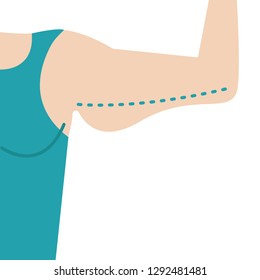 Liposuction of arms. Close vector illustration of  body contour with dotted line. Plastic surgery. Getting rid of excess fat.