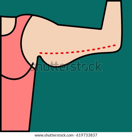 Liposuction of arms. Close vector illustration of  body contour with dotted line. Plastic surgery. Getting rid of excess fat