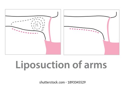 Liposuction of arms. Plastic surgery. Vector illustration of Arm with dotted line