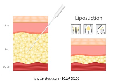 Liposuction before and after , fat , cosmetic . step of Liposuction and icon