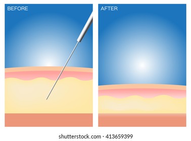 Liposuction before and after , fat , cosmetic skin .