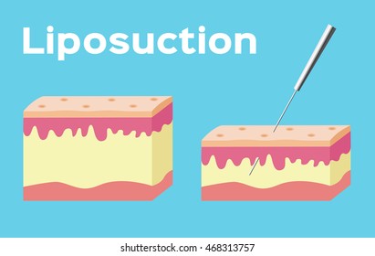 Liposuction before and after , fat , cosmetic . 