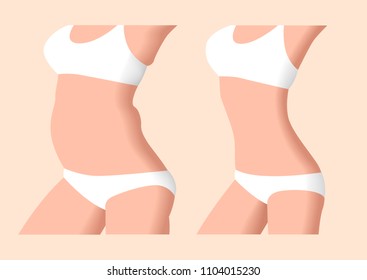 liposuction before and after , fat , diet , surgery