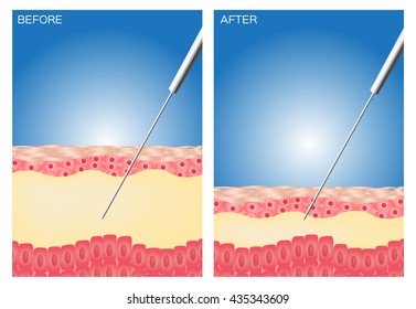 Liposuction before and after , fat , diet , surgery 