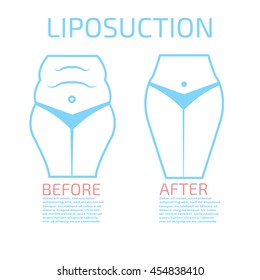 Liposuction before and after info graphics