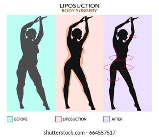 Liposuction before and after. Plastic surgery infographic of Aesthetic Procedures