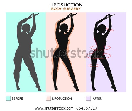 Liposuction before and after. Plastic surgery infographic of Aesthetic Procedures