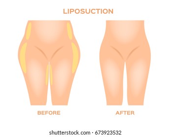 Liposuction before and after vector