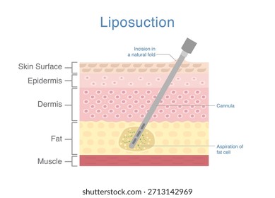 Lipoaspiração por Cannula com diagrama de camada de pele em estilo plano. Insira a agulha na camada de gordura em excesso e se livrar por sução na área de redução.