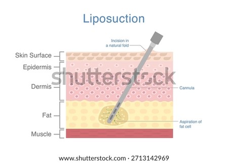 Liposuction by Cannula with skin layer diagram in flat style. Insert needle in to excess fat layer and get rid by suction on reduce area.