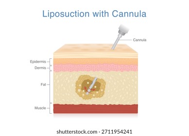Lipoaspiração com Cânula. Inserir agulha médica na camada de gordura da pele para sução excesso de gordura e reduzir a forma e alterar a proporção corporal.