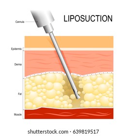 Liposuction. fat modeling. Cannula into the fat layer beneath skin.