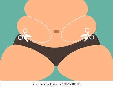 Liposuction and fat reduction - overweight fatty person with belly fat is going to have aesthetic surgery  to lose weight. Vector illustration