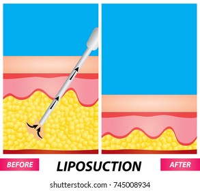 Liposuction , fat surgery diagram before and after vector illustration
