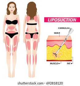 liposucción , cirugía grasa ilustración vectorial