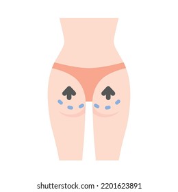 diseño plano de liposucción. Cirugía estética en el cuerpo femenino con líneas punteadas. Para clínicas de cirugía plástica, publicaciones médicas y de belleza. Ilustración vectorial.