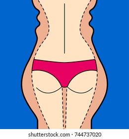 Liposuction. Hips, thighs, buttocks. Removal of fat. Plastic surgery. Stock vector