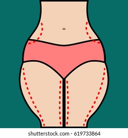 Liposuction of hips and thighs. Close vector illustration of body contour with dotted line. Plastic surgery. Getting rid of excess fat.