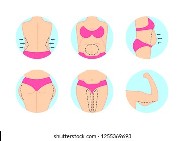 
Liposuction. Liposuction hips, thighs, stomach. Removal of fat. Plastic surgery. Stock vector.