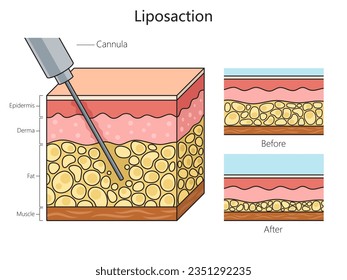 Liposuction lipo fat removal procedure diagram schematic vector illustration. Medical science educational illustration