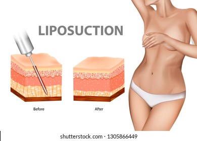Liposuction or lipo. The Human Skin layer before lipo and after Liposuction. Plastic surgery infographic of Aesthetic Procedures