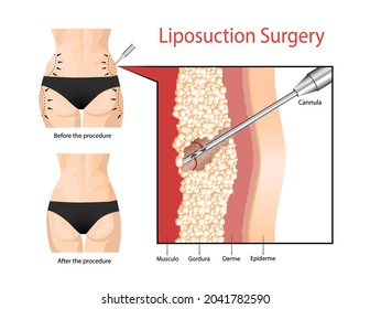 Liposuction. The operation to clean the fat layer under the skin.