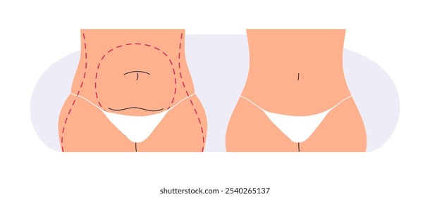 Liposuction, plastic surgery, before and after. Fat belly and slim waist. Aesthetic body transformation, weight loss in waistline, abdomen. Flat vector illustration isolated on white background