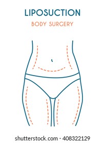 Liposuction poster. Modern vector illustration. svg
